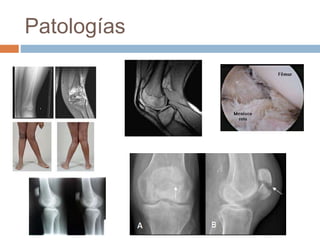 Tibia Rot Articulacion de la rodilla | PPTX