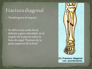 Tibia y perone | PPT