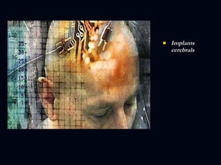 Implants cerebrals  