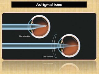Astigmatismo