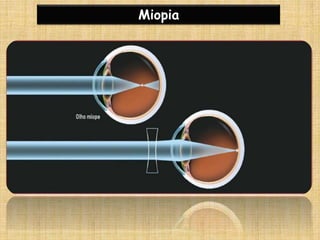 Miopia