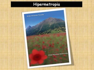 Hipermetropia
 
