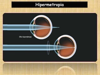 Hipermetropia
 