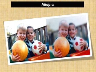 Miopia
 