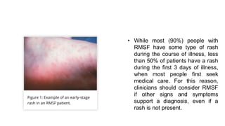 Mono Vs Rmsf Rash Tick borne diseases | PPTX