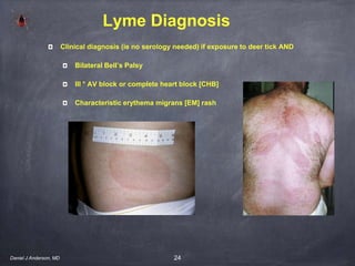 24
Lyme Diagnosis
Clinical diagnosis (ie no serology needed) if exposure to deer tick AND
Bilateral Bell’s Palsy
III ° AV block or complete heart block [CHB]
Characteristic erythema migrans [EM] rash
Daniel J Anderson, MD
 