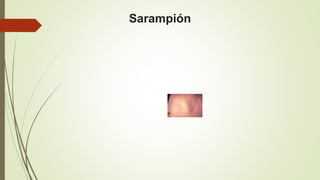 Sarampión
 