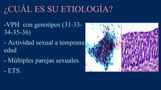 ¿CUÁL ES SU ETIOLOGÍA?
-VPH con genotipos (31-33-
34-35-36)
- Actividad sexual a temprana
edad
- Múltiples parejas sexuale...
