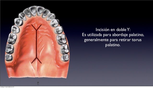 Resultado de imagen para tipos de incisiones en odontologia doble y