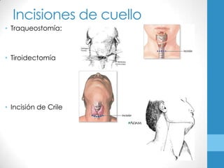 Incisiones de cuello
• Traqueostomía:



• Tiroidectomía




• Incisión de Crile
 