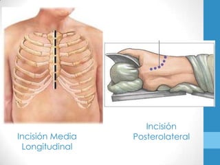 Incisión
Incisión Media   Posterolateral
 Longitudinal
 