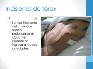 Incisiones de tórax
• T                as
  • Son las incisiones
    del rax que
    suelen
    prolongarse al
    abdomen
    cuando se
    ingresa a las dos
    cavidades.
 