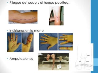 • Pliegue del codo y el hueco poplíteo:




• Incisiones en la mano




• Amputaciones
 