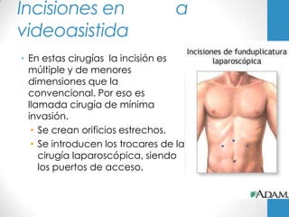 Incisiones en                      a
videoasistida
• En estas cirugías la incisión es
  múltiple y de menores
  dimensiones que la
  convencional. Por eso es
  llamada cirugía de mínima
  invasión.
   • Se crean orificios estrechos.
   • Se introducen los trocares de la
     cirugía laparoscópica, siendo
     los puertos de acceso.
 