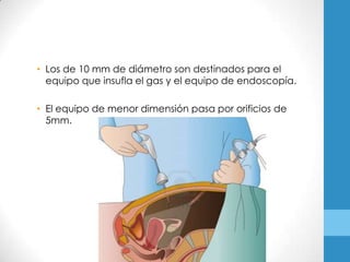 • Los de 10 mm de diámetro son destinados para el
  equipo que insufla el gas y el equipo de endoscopía.

• El equipo de menor dimensión pasa por orificios de
  5mm.
 
