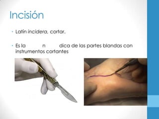 Incisión
• Latín incidera, cortar.

• Es la      n      dica de las partes blandas con
  instrumentos cortantes
 