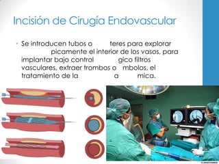 Incisión de Cirugía Endovascular
• Se introducen tubos o      teres para explorar
           picamente el interior de los vasos, para
  implantar bajo control        gico filtros
  vasculares, extraer trombos o mbolos, el
  tratamiento de la            a       mica.
 