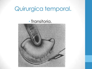 Quirurgica temporal.

    • Transitoria.
 