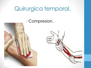 Quirurgica temporal.

    • Compresion.
 