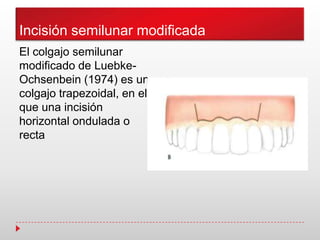 Incisión semilunar modificada
El colgajo semilunar
modificado de Luebke-
Ochsenbein (1974) es un
colgajo trapezoidal, en el
que una incisión
horizontal ondulada o
recta
 