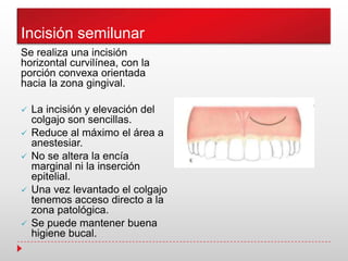 Incisión semilunar
Se realiza una incisión
horizontal curvilínea, con la
porción convexa orientada
hacia la zona gingival.
 La incisión y elevación del
colgajo son sencillas.
 Reduce al máximo el área a
anestesiar.
 No se altera la encía
marginal ni la inserción
epitelial.
 Una vez levantado el colgajo
tenemos acceso directo a la
zona patológica.
 Se puede mantener buena
higiene bucal.
 