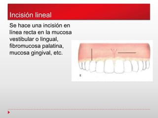 Incisión lineal
Se hace una incisión en
línea recta en la mucosa
vestibular o lingual,
fibromucosa palatina,
mucosa gingival, etc.
 