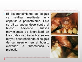  El desprendimiento de colgajo
se realiza mediante una
espatula o periostótomo. Este
se utiliza apoyándose contra el
hueso haciendo suaves
movimientos de lateralidad en
los cuales se gira sobre su eje
mayor, desprendiendo el colgajo
de su inserción en el hueso,
elevando la fibromucosa y
preiostio.
 