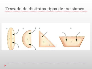 Trazado de distintos tipos de incisiones
 