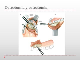 Osteotomía y ostectomía
 