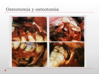 Osteotomía y osteotomía
 