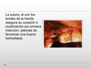 La sutura, al unir los
bordes de la herida
asegura su curación o
cicatrización por primera
intención, además de
favorecer una buena
hemostasia.
 