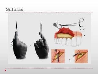 Suturas
 