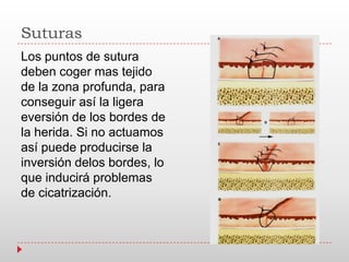 Suturas
Los puntos de sutura
deben coger mas tejido
de la zona profunda, para
conseguir así la ligera
eversión de los bordes de
la herida. Si no actuamos
así puede producirse la
inversión delos bordes, lo
que inducirá problemas
de cicatrización.
 