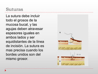 Suturas
La sutura debe incluir
todo el grosos de la
mucosa bucal, y las
agujas deben atravesar
espesores iguales en
ambos lados y ser
equidistantes de la línea
de incisión. La sutura es
mas precisa cuando los
bordes unidos son del
mismo grosor.
 