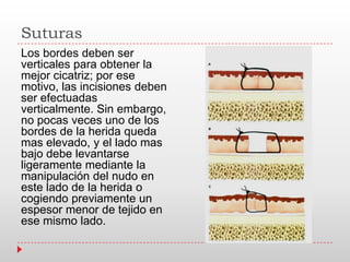 Suturas
Los bordes deben ser
verticales para obtener la
mejor cicatriz; por ese
motivo, las incisiones deben
ser efectuadas
verticalmente. Sin embargo,
no pocas veces uno de los
bordes de la herida queda
mas elevado, y el lado mas
bajo debe levantarse
ligeramente mediante la
manipulación del nudo en
este lado de la herida o
cogiendo previamente un
espesor menor de tejido en
ese mismo lado.
 