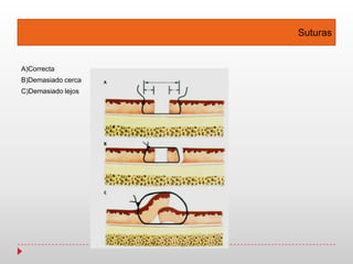 Suturas
A)Correcta
B)Demasiado cerca
C)Demasiado lejos
 