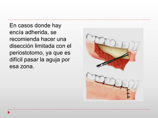 En casos donde hay
encía adherida, se
recomienda hacer una
disección limitada con el
periostotomo, ya que es
difícil pasar la aguja por
esa zona.
 