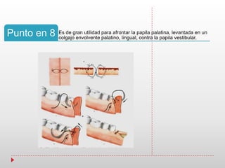 Es de gran utilidad para afrontar la papila palatina, levantada en un
colgajo envolvente palatino, lingual, contra la papila vestibular.
Punto en 8
 
