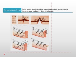 Es un punto en vertical que se utiliza cuando es necesaria
cierta tensión en los bordes de la herida.
Punto de Blair-Donati
 