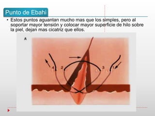 Punto de Ebahi
• Estos puntos aguantan mucho mas que los simples, pero al
soportar mayor tensión y colocar mayor superficie de hilo sobre
la piel, dejan mas cicatriz que ellos.
 
