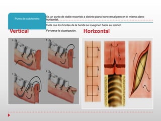 Es un punto de doble recorrido a distinto plano transversal pero en el mismo plano
horizontal.
Evita que los bordes de la herida se invaginen hacia su interior.
Favorece la cicatrización.
Punto de colchonero
Vertical Horizontal
 
