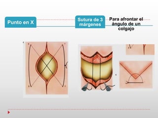 Punto en X
Para afrontar el
ángulo de un
colgajo
Sutura de 3
márgenes
 
