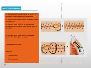 Sutura continua simple
Se coloca primero un punto simple, se anuda y se
secciona al extremo libre que no tiene aguja.
Se van colocando puntos simples separados entre si
unos 5 a 10mm.
Se tracciona el hilo con el fin de aproximar los
bordes cruentos, repitiendo hasta llegar al borde de
la incisión.
Se coloca el ultimo punto con los bordes de la
incisión bien afrontados y se anuda.
Tiende a elevar la herida
Puede ser:
• Simple oblicua
• Simple paralela
 