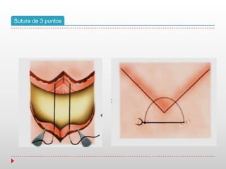 Sutura de 3 puntos
 