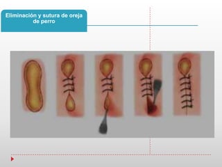 Eliminación y sutura de oreja
de perro
 