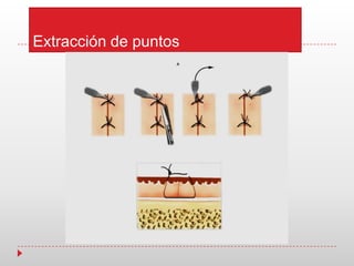 Extracción de puntos
 