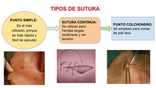 TIPOS DE SUTURA
PUNTO SIMPLE:
Es el más
utilizado, porque
es más rápido y
fácil de ejecutar
SUTURA CONTINUA:
Se utilizan para
heridas largas,
rectilíneas y sin
tensión
PUNTO COLCHONERO:
Se emplean para zonas
de piel laxa
 