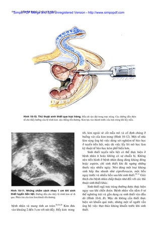 408 SIEÂU AÂM BUÏNG, CHAÄU VAØ NGÖÏC
beänh nhaân vaø mang tính an toaøn.20,26,28
Kim ñöa
vaøo khoaûng 2 ñeán 3 cm vôùi nuùt ñaåy. Ñaåy kim trong
Hình 10-10. Thuû thuaät sinh thieát qua tröïc traøng. Ñaàu doø taän ñaët trong tröïc traøng. Caùc ñöôøng daãn ñieän
töû cho thaáy höôùng cuûa loä trình kim doïc thaúng toån thöông. Kim töïa vaøo thaønh tröôùc cuûa tröïc traøng khi laáy maãu.
tôùi, kim ngoaøi seõ caét maãu moâ vaø coá ñònh chuùng ôû
buoàng vaùt cuûa kim trong (Hình 10-12). Moät soá nhaø
laâm saøng uûng hoä vieäc duøng xeùt nghieäm teá baøo hoïc
ôû tuyeán tieàn lieät, maëc duø vieäc laáy loõi moâ hoïc laøm
kyõ thuaät teá baøo hoïc keùm phoå bieán hôn.
Sinh thieát tuyeán tieàn lieät coù theå thöïc hieän ôû
beänh nhaân ít hoaëc khoâng coù söï chuaån bò. Khoâng
neân tieán haønh ôû beänh nhaân ñang duøng khaùng ñoâng
hoaëc aspirin, chæ sinh thieát khi ñaõ ngöng nhöõng
thuoác naøy nhieàu ngaøy. Neân duøng moät loaïi khaùng
sinh haáp thu nhanh nhö ciprofloxacin, moät lieàu
ngay tröôùc vaø nhieàu lieàu sau khi sinh thieát.29-31
Giaûi
thích cho beänh nhaân chaáp thuaän nhö ñoái vôùi caùc thuû
thuaät sinh thieát khaùc.
Sinh thieát ngaû tröïc traøng thöôøng ñöôïc thöïc hieän
ngay sau khi chaån ñoaùn. Beänh nhaân vaãn naèm ôû tö
theá nghieâng traùi vaø gaén duïng cuï sinh thieát vaøo ñaàu
doø (Hình 10-8, B). Maëc duø khoâng caàn thieát thöïc
hieän saùt khuaån quaù möùc, nhöng moät soá ngöôøi vaãn
uûng hoä vieäc thuït thaùo khaùng khuaån tröôùc khi sinh
thieát.
Hình 10-11. Nhöõng chaám caùch nhau 1 cm khi sinh
thieát tuyeán tieàn lieät. Ñöôøng daãn cho thaáy loä trình kim seõ ñi
qua. Phaûn aâm cuûa kim laøm khuaát toån thöông.
Simpo PDF Merge and Split Unregistered Version - http://www.simpopdf.com
 