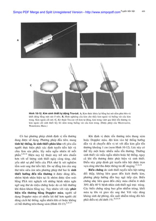 409Tuyeán tieàn lieät
Coù hai phöông phaùp chính ñònh vò toån thöông
ñang ñöôïc söû duïng. Phöông phaùp ñaàu tieân, mang
tính heä thoáng, laø sinh thieát phaân khu vôùi yeâu caàu
ngöôøi thöïc hieän phaûi xaùc ñònh tuyeán tieàn lieät vaø
chia laøm saùu phaàn, laáy maãu ngaãu nhieân töø moãi
phaàn.6,30-34
Hieän nay kyõ thuaät naøy trôû neân chuaån
hôn vôùi soá löôïng sinh thieát ngaøy caøng taêng, chuû
yeáu nhôø söï phoå bieán cuûa PSA nhö laø xeùt nghieäm
taàm soaùt ung thö tieàn lieät. Do söï ñaúng aâm cuûa ung
thö treân sieâu aâm neân phöông phaùp thöù hai laø sinh
thieát höôùng ñeán toån thöông ít ñöôïc duøng ñeán,
nhoùm beänh nhaân hieän taïi laø nhoùm ñöôïc taàm soaùt
baèng PSA traùi nghòch vôùi nhöõng beänh nhaân nghi
ngôø ung thö do trieäu chöùng hoaëc do coù baát thöôøng
khi thaêm khaùm baèng tay. Tuy nhieân vôùi vieäc phaùt
hieän toån thöông baèng Doppler maøu, ngöôøi söû
duïng Doppler maøu coù nhieàu lôïi theá hôn ngöôøi chæ
duøng caùch heä thoáng, ngaãu nhieân khi coù hoaëc khoâng
coù baát thöôøng treân thang xaùm (Hình 10-13).8,35-37
Hình 10-12. Kim sinh thieát töï doäng Tru-cut. A, Kim ñöôïc khoùa laïi baèng hai nuùt naèm phía beân vaø
khôûi ñoäng baèng moät nuùt ôû treân. B, Hình nghieâng cuûa kim cho thaáy kim ngoaøi vaø buoàng vaùt cuûa kim
trong. Kim ngoaøi caét moâ. C, Kyõ thuaät Tru-cut vôùi kim töï ñoäng, kim trong vöôït qua khoûi toån thöông vaø
kim ngoaøi caét sinh thieát laáy loõi naèm trong buoàng vaùt cuûa kim trong. (Ñöôïc pheùp cuûa Microvasive,
Watertown, Mass.)
Khi ñònh vò ñöôïc toån thöông treân thang xaùm
hoaëc Doppler maøu, ñaët kim vaøo heä thoáng höôùng
daãn vaø di chuyeån ñeán vò trí vôùi ñaàu kim gaàn toån
thöông khoaûng 1 cm (xem Hình 10-12). Luùc naøy coù
theå laáy moät hoaëc nhieàu maãu toån thöông. Thöôøng
sinh thieát vaøi maãu ngaãu nhieân hoaëc heä thoáng, ngay
caû khi toån thöông ñöôïc phaùt hieän vaø sinh thieát.
Ñieàu naøy giuùp ñaùnh giaù tuyeán tieàn lieät ñöôïc troïn
veïn cuõng nhö thu ñöôïc thoâng tin ñeå staging.33,34,38
Bieán chöùng do sinh thieát tuyeán tieàn lieät töông
ñoái thaáp, khoâng lieân quan ñeán kích thöôùc kim,
phöông phaùp höôùng daãn hay ngaû tieáp caän. Bieán
chöùng nheï lieân quan ñeán chaûy maùu chieám ít nhaát
30% ñeán 40 % beänh nhaân sinh thieát ngaû tröïc traøng.
Caùc bieán chöùng naëng bao goàm nhieãm truøng, khoái
maùu tuï lôùn vaø gieo raéc ung thö. Vôùi vieäc duøng
khaùng sinh döï phoøng, taàn suaát nhieãm truøng ñoøi hoûi
phaûi ñieàu trò chæ döôùi 1%.28,29,39
Simpo PDF Merge and Split Unregistered Version - http://www.simpopdf.com
 