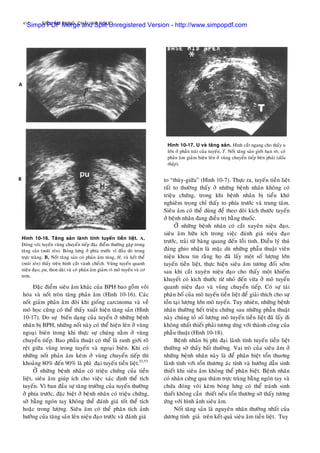412 SIEÂU AÂM BUÏNG, CHAÄU VAØ NGÖÏC
Ñaëc ñieåm sieâu aâm khaùc cuûa BPH bao goàm voâi
hoùa vaø noát troøn taêng phaûn aâm (Hình 10-16). Caùc
noát giaûm phaûn aâm ñoâi khi gioáng carcinoma vaø veà
moâ hoïc cuõng coù theå thaáy xuaát hieän taêng saûn (Hình
10-17). Do söï bieán daïng cuûa tuyeán ôû nhöõng beänh
nhaân bò BPH, nhöõng noát naøy coù theå hieän leân ôû vuøng
ngoaïi bieân trong khi thöïc söï chuùng naèm ôû vuøng
chuyeån tieáp. Bao phaãu thuaät coù theå laø ranh giôùi roõ
reät giöõa vuøng trong tuyeán vaø ngoaïi bieân. Khi coù
nhöõng noát phaûn aâm keùm ôû vuøng chuyeån tieáp thì
khoaûng 80% ñeán 90% laø phì ñaïi tuyeán tieàn lieät.52,53
ÔÛ nhöõng beänh nhaân coù trieäu chöùng cuûa tieàn
lieät, sieâu aâm giuùp ích cho vieäc xaùc ñònh theå tích
tuyeán. Vì ban ñaàu söï taêng tröôûng cuûa tuyeán thöôøng
ôû phía tröôùc, ñaëc bieät ôû beänh nhaân coù trieäu chöùng,
sôø baèng ngoùn tay khoâng theå ñaùnh giaù toát theå tích
hoaëc trong löôïng. Sieâu aâm coù theå phaân tích aûnh
höôûng cuûa taêng saûn leân nieäu ñaïo tröôùc vaø ñaùnh giaù
Hình 10-17. U vaø taêng saûn. Hình caét ngang cho thaáy u
lôùn ôû phaàn traùi cuûa tuyeán, T. Noát taêng saûn giôùi haïn roõ, coù
phaûn aâm giaûm hieän leân ôû vuøng chuyeån tieáp beân phaûi (daáu
thaäp).
to “thuøy-giöõa” (Hình 10-7). Thöïc ra, tuyeán tieàn lieät
raát to thöôøng thaáy ôû nhöõng beänh nhaân khoâng coù
trieäu chöùng, trong khi beänh nhaân bò tieåu khoù
nghieâm troïng chæ thaáy to phía tröôùc vaø trung taâm.
Sieâu aâm coù theå duøng ñeå theo doõi kích thöôùc tuyeán
ôû beänh nhaân ñang ñieàu trò baèng thuoác.
ÔÛ nhöõng beänh nhaân coù caét xuyeân nieäu ñaïo,
sieâu aâm höõu ích trong vieäc ñaùnh giaù nieäu ñaïo
tröôùc, traûi töø baøng quang ñeán loài tinh. Ñieàu lyù thuù
ñaùng ghio nhaän laø maëc duø nhöõng phaãu thuaät vieân
nieäu khoa tin raèng hoï ñaõ laáy moät soá löôïng lôùn
tuyeán tieàn lieät, thöïc hieän sieâu aâm töông ñoái sôùm
sau khi caét xuyeân nieäu ñaïo cho thaáy moät khieám
khuyeát coù kích thöôùc töø nhoû ñeán vöøa ôû moâ tuyeán
quanh nieäu ñaïo vaø vuøng chuyeån tieáp. Coù söï taùi
phaân boá cuûa moâ tuyeán tieàn lieät ñeå giaûi thích cho söï
toàn taïi löôïng lôùn moâ tuyeán. Tuy nhieân, nhöõng beänh
nhaân thöôøng heát trieäu chöùng sau nhöõng phaãu thuaät
naøy chuùng toû soá löôïng moâ tuyeán tieàn lieät ñaõ laáy ñi
khoâng nhaát thieát phaûi töông öùng vôùi thaønh coâng cuûa
phaãu thuaät (Hình 10-18).
Hình 10-16. Taêng saûn laønh tính tuyeán tieàn lieät. A,
Ñoùng voâi tuyeán vuøng chuyeån tieáp ñaëc ñieåm thöôøng gaëp trong
taêng saûn (muõi teân). Boùng löng ôû phía tröôùc vì ñaàu doø trong
tröïc traøng. B, Noát taêng saûn coù phaûn aâm taêng, H, vaø keát theå
(muõi teân) thaáy treân hình caét vaønh cheách. Vuøng tuyeán quanh
nieäu ñaïo, pu, thon daøi vaø coù phaûn aâm giaûm vì moâ tuyeán vaø cô
trôn.
Beänh nhaân bò phì ñaïi laønh tính tuyeán tieàn lieät
thöôøng sôø thaáy baát thöôøng. Vai troø cuûa sieâu aâm ôû
nhöõng beänh nhaân naøy laø ñeå phaân bieät toån thuông
laønh tính vôùi toån thöông aùc tính vaø höôùng daãn sinh
thieát khi sieâu aâm khoâng theå phaân bieät. Beänh nhaân
coù nhaân cöùng qua thaêm tröïc traøng baèng ngoùn tay vaø
chöùa ñoùng voâi keøm boùng löng coù theå traùnh sinh
thieát khoâng caàn thieát neáu toån thöông sôø thaáy töông
öùng vôùi hình aûnh sieâu aâm.
Noát taêng saûn laø nguyeân nhaân thöôøng nhaát cuûa
döông tính giaû treân keát quaû sieâu aâm tieàn lieät. Tuy
Simpo PDF Merge and Split Unregistered Version - http://www.simpopdf.com
 